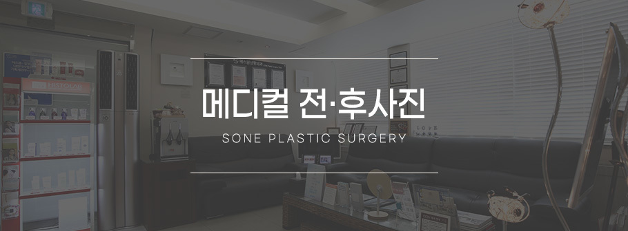 전후사진