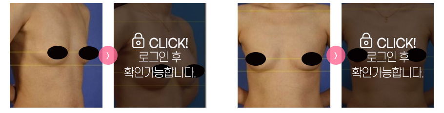 가슴성형