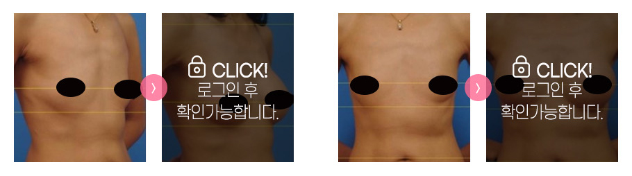 가슴성형