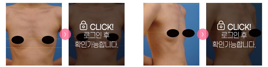 가슴성형