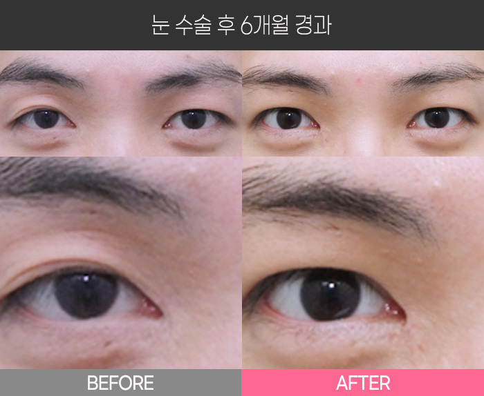눈 수술 후 6개월 경과
