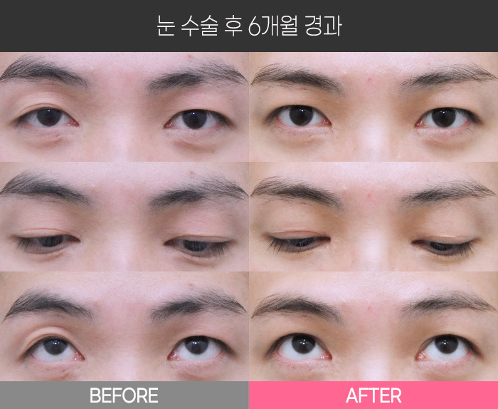 눈 수술 후 6개월 경과
