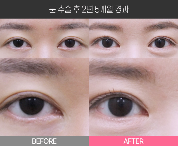 눈 수술 후 2년  5개월 경과