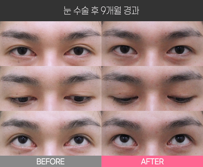 눈 수술 후 9개월 경과