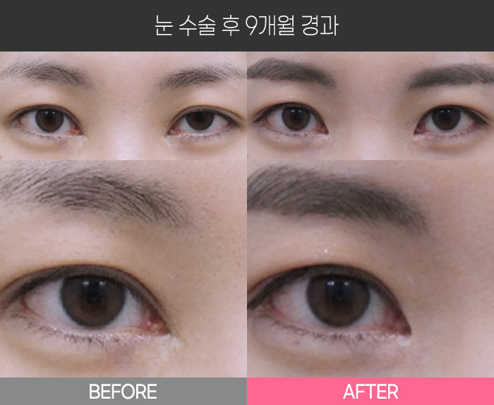 눈 수술 후 9개월 경과
