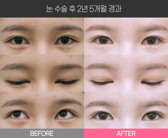 눈 수술 후 2년 5개월 경과