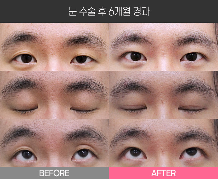 눈 수술 후 6개월 경과