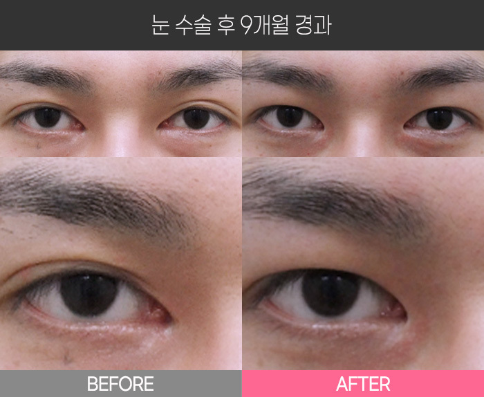 눈 수술 후 9개월 경과