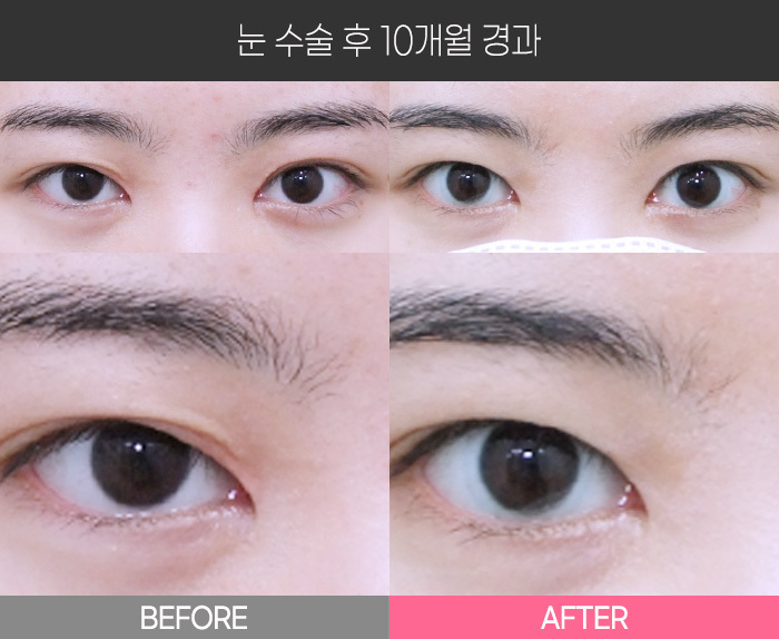 눈 수술 후 10개월 경과