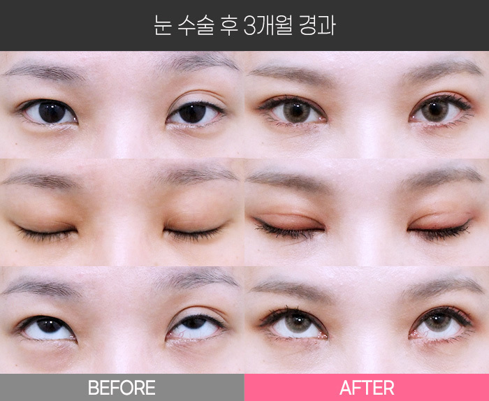 눈 수술 후 3개월 경과
