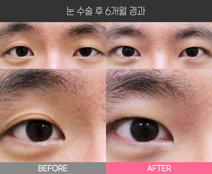 눈 수술 후 6개월 경과