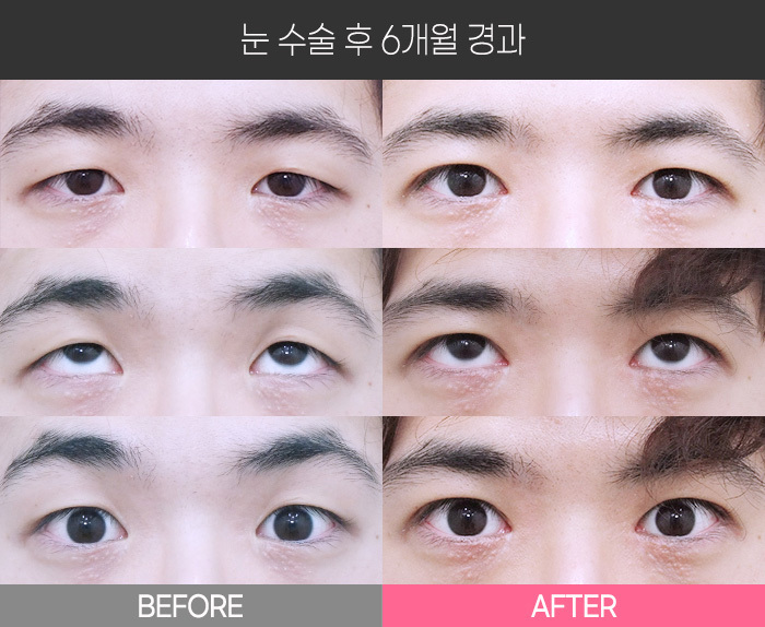 눈 수술 후 6개월 경과
