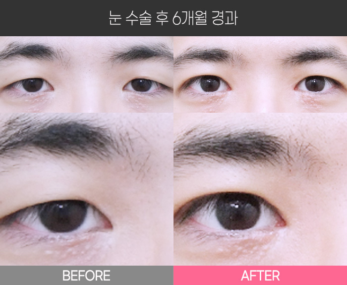눈 수술 후 6개월 경과