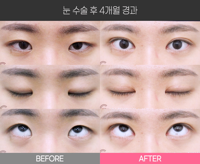 눈 수술 후 4개월 경과