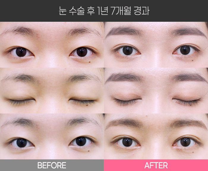 눈 수술 후 1년 7개월 경과