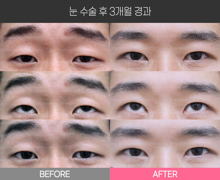 눈 수술 후 3개월 경과