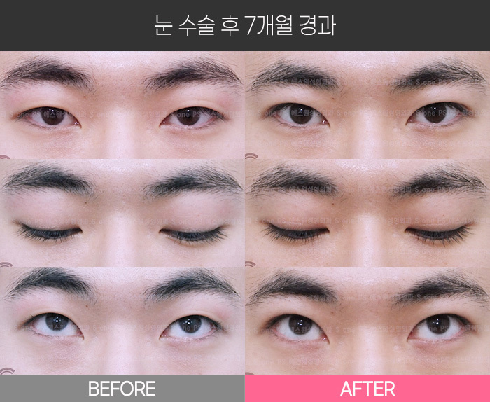 눈 수술 후 7개월 경과
