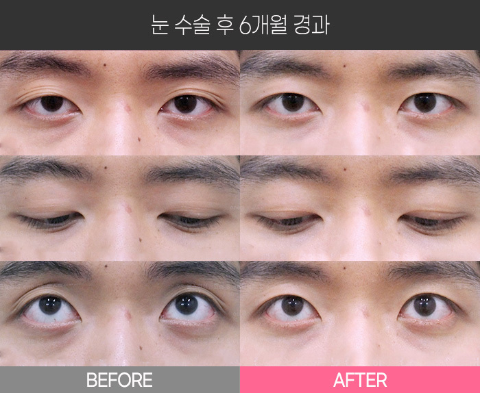 눈 수술 후 6개월 경과