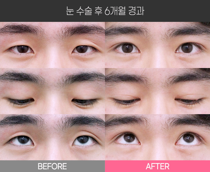 눈 수술 후 6개월 경과