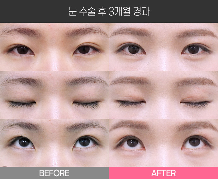 눈 수술 후 3개월 경과