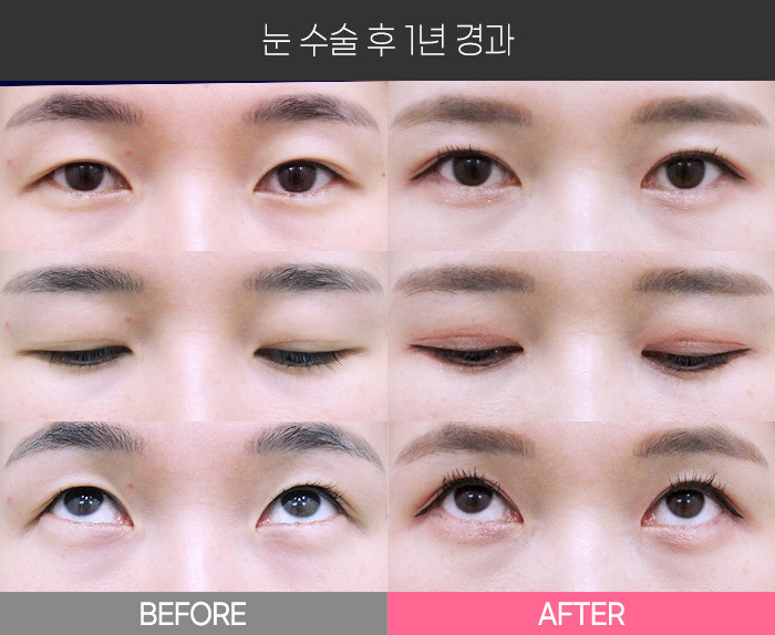 눈 수술 후 1년 경과
