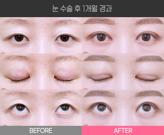 눈 수술 후 1개월 경과
