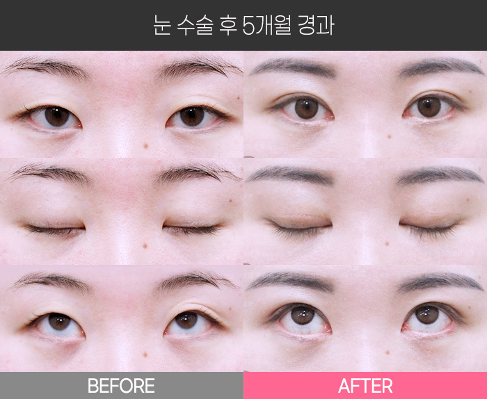 눈 수술 후 1개월 경과