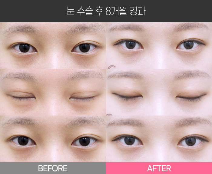 눈 수술 후 8개월 경과