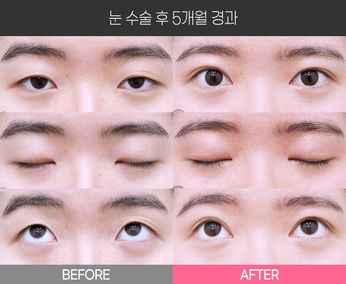 눈 수술 후 5개월 경과
