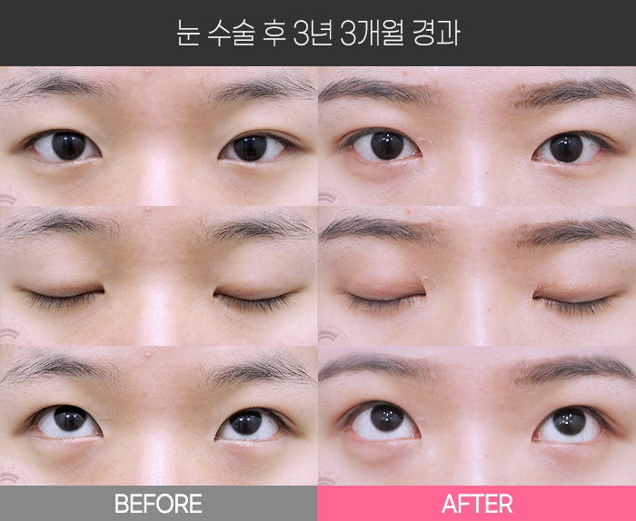 눈 수술 후 3년 3개월 경과