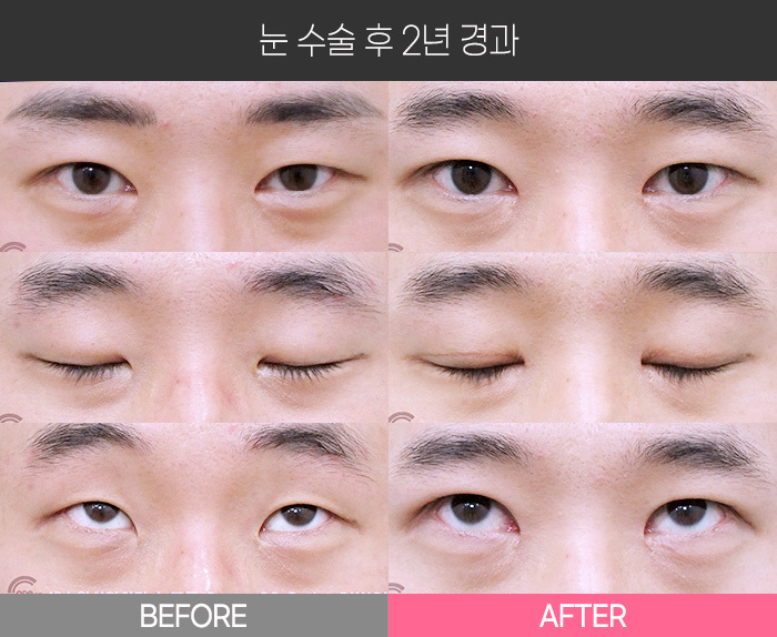 눈 수술 후 2년 경과