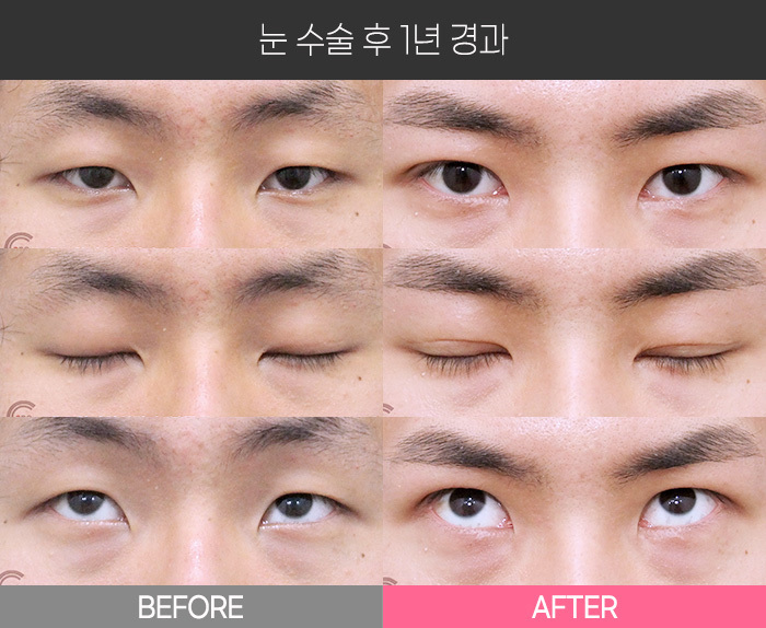 눈 수술 후 1년 경과