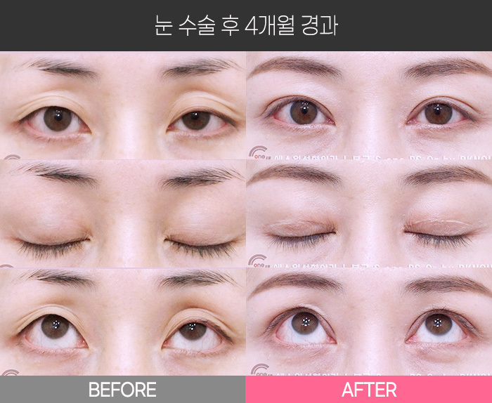 눈 수술 후 4개월 경과