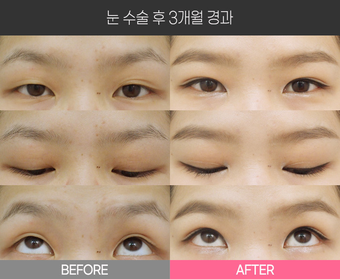 눈 수술 후 3개월 경과