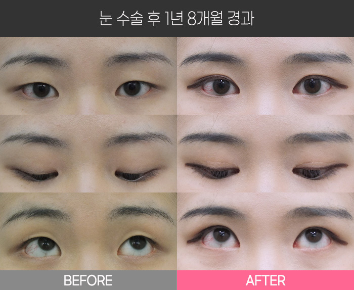 눈 수술 후 1년 8개월 경과
