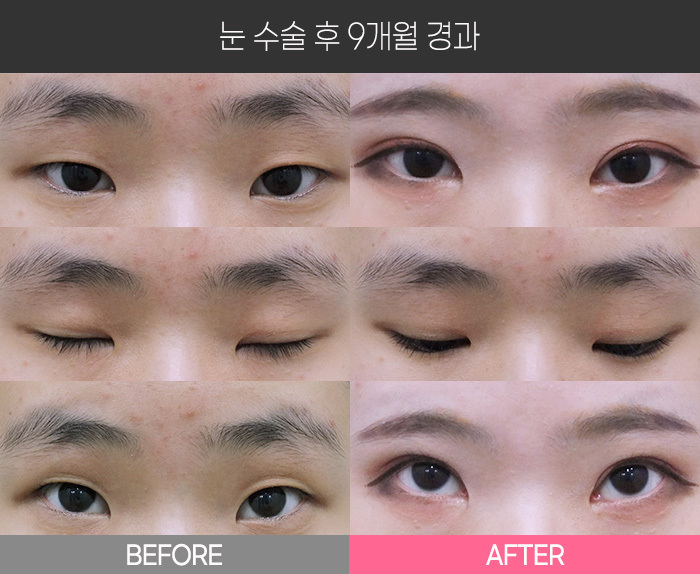 눈 수술 후 9개월 경과