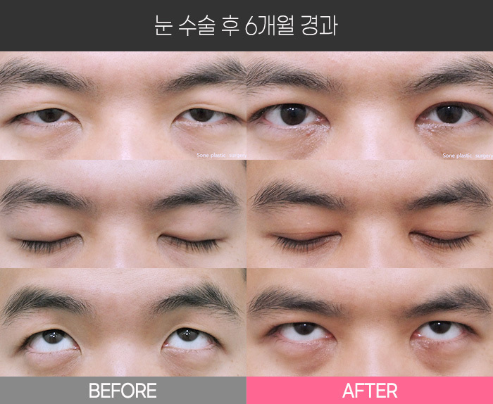눈 수술 후 6개월 경과