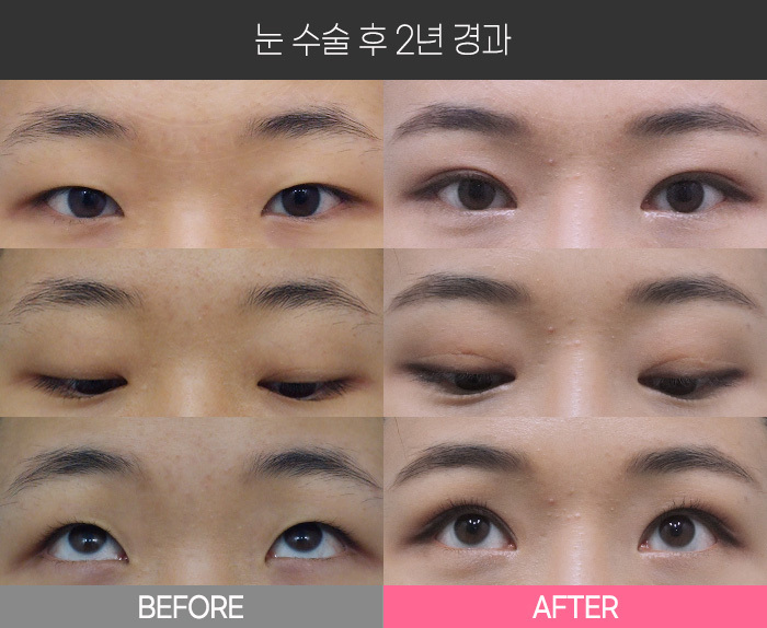 눈 수술 후 2년 경과