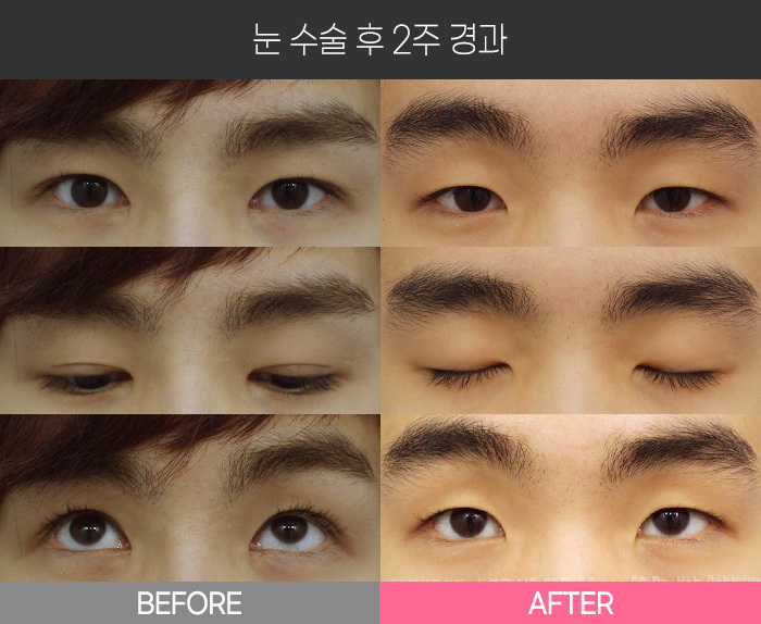 눈 수술 후 2주 경과