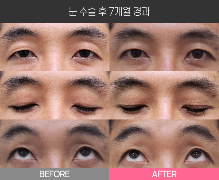 눈 수술 후 7개월 경과