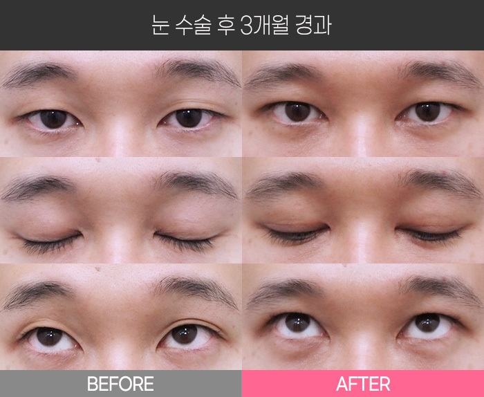 눈 수술 후 3개월 경과
