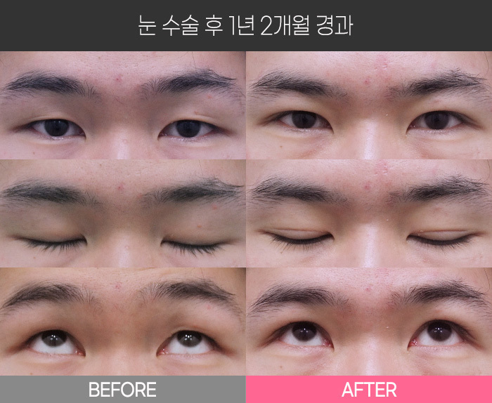 눈 수술 후 1년2개월 경과