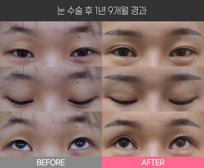 눈 수술 후 1년9개월 경과