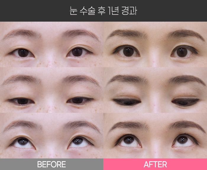눈 수술 후 1년 경과