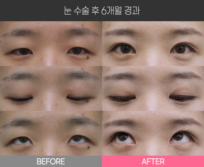 눈 수술 후 6개월 경과