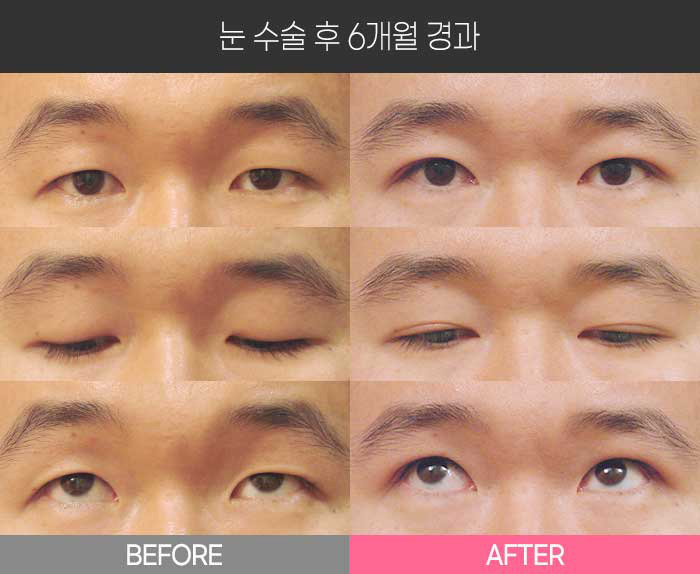 눈 수술 후 6개월 경과
