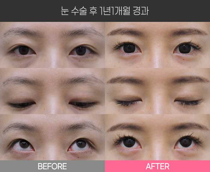 눈 수술 후 1년1개월 경과