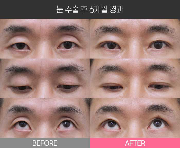 눈 수술 후 6개월 경과