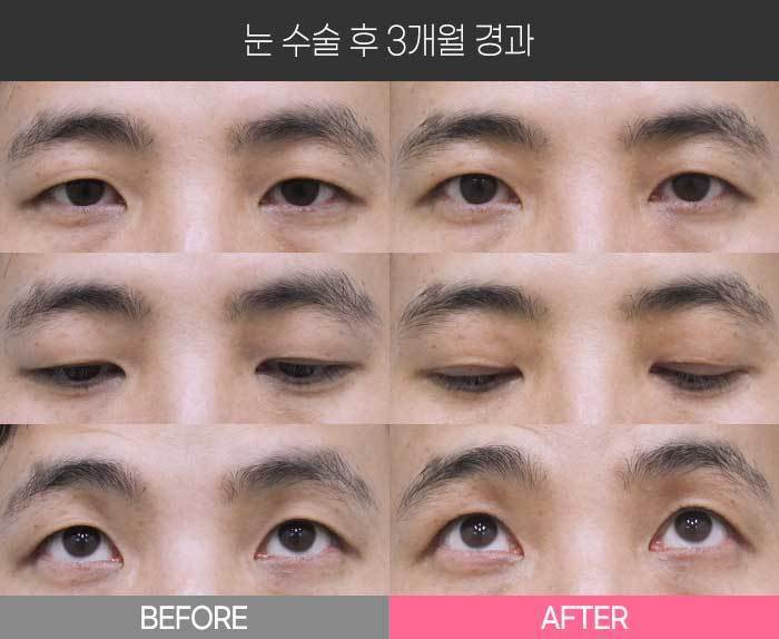 눈 수술 후 3개월 경과