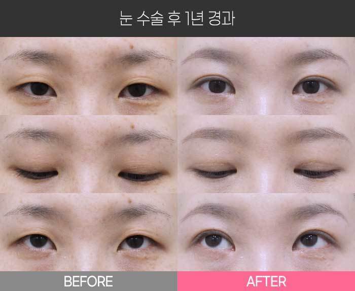눈 수술 후 1년 경과